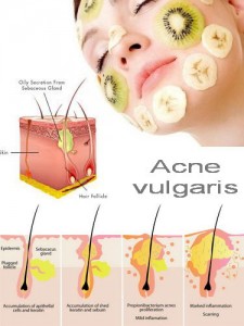 Diseases - Acne - 1