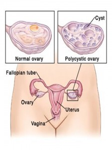 Diseases - PCOD - 1