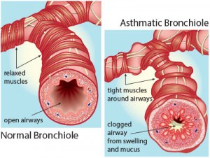 Diseases - Asthma - Asthmatic bronchiole